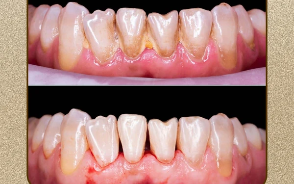 Tratamento periodontal em Uberaba